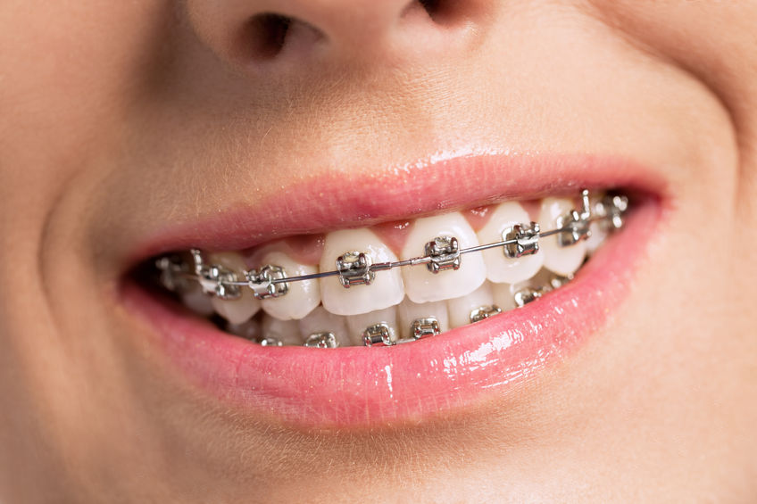  [company_name_branding]sonrisa con ortodoncia