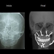 Ortodoncia Carlton pacientes con patologías especiales 8