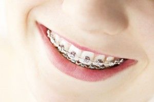  [company_name_branding]persona con tratamiento de ortodoncia