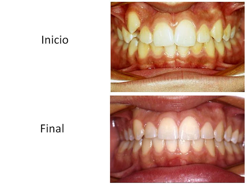 Ortodoncia Carlton ortodoncia antes y después