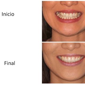 Ortodoncia Carlton caso 4 antes y después