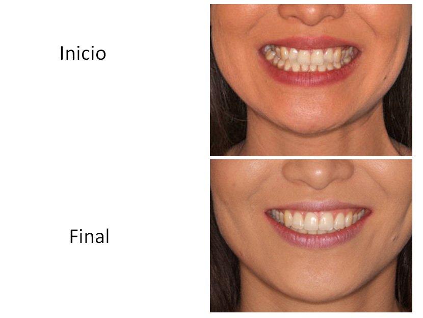 Ortodoncia Carlton caso 4 antes y después