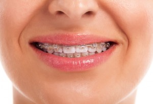 [company_name_branding] mujer adulta con ortodoncia