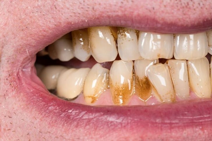 Los dentistas coinciden: esta es la forma correcta para limpiar y  desinfectar la férula dental