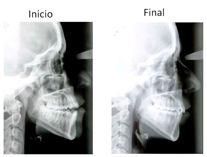 Ortodoncia Carlton caso 6 radiografía 