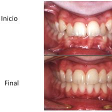 Ortodoncia Carlton dentadura antes y después
