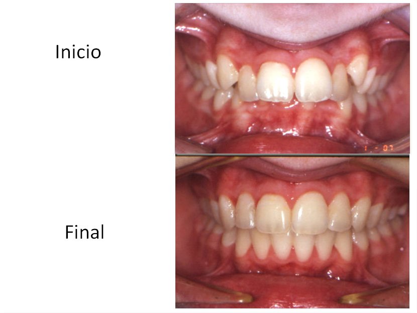 Ortodoncia Carlton dentadura antes y después