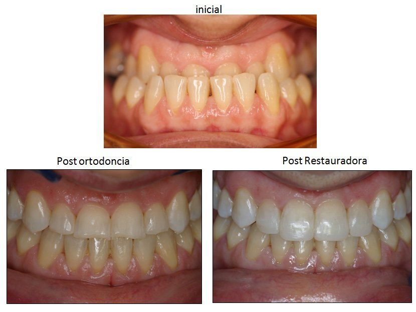Ortodoncia Carlton caso 3 ortodoncia adultos