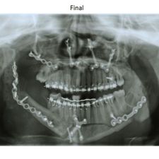 Ortodoncia Carlton pacientes con patologías especiales 3