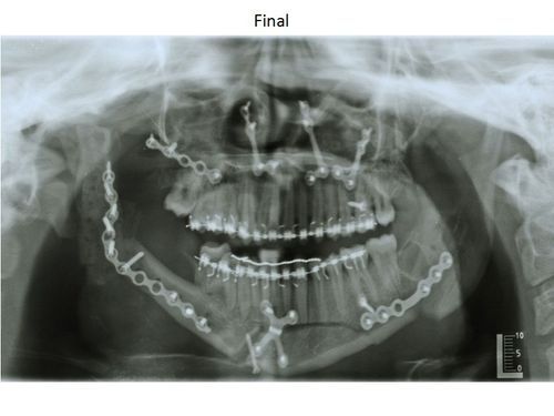 Ortodoncia Carlton pacientes con patologías especiales 3