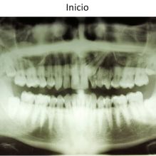 Ortodoncia Carlton ortodoncia invisible 1