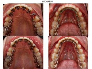 [company_name_branding] ortodoncia lingual