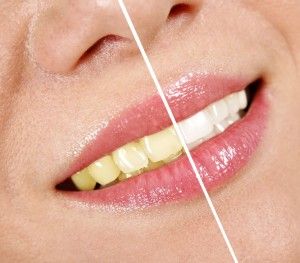 [company_name_branding] dientes amarillos y blancos