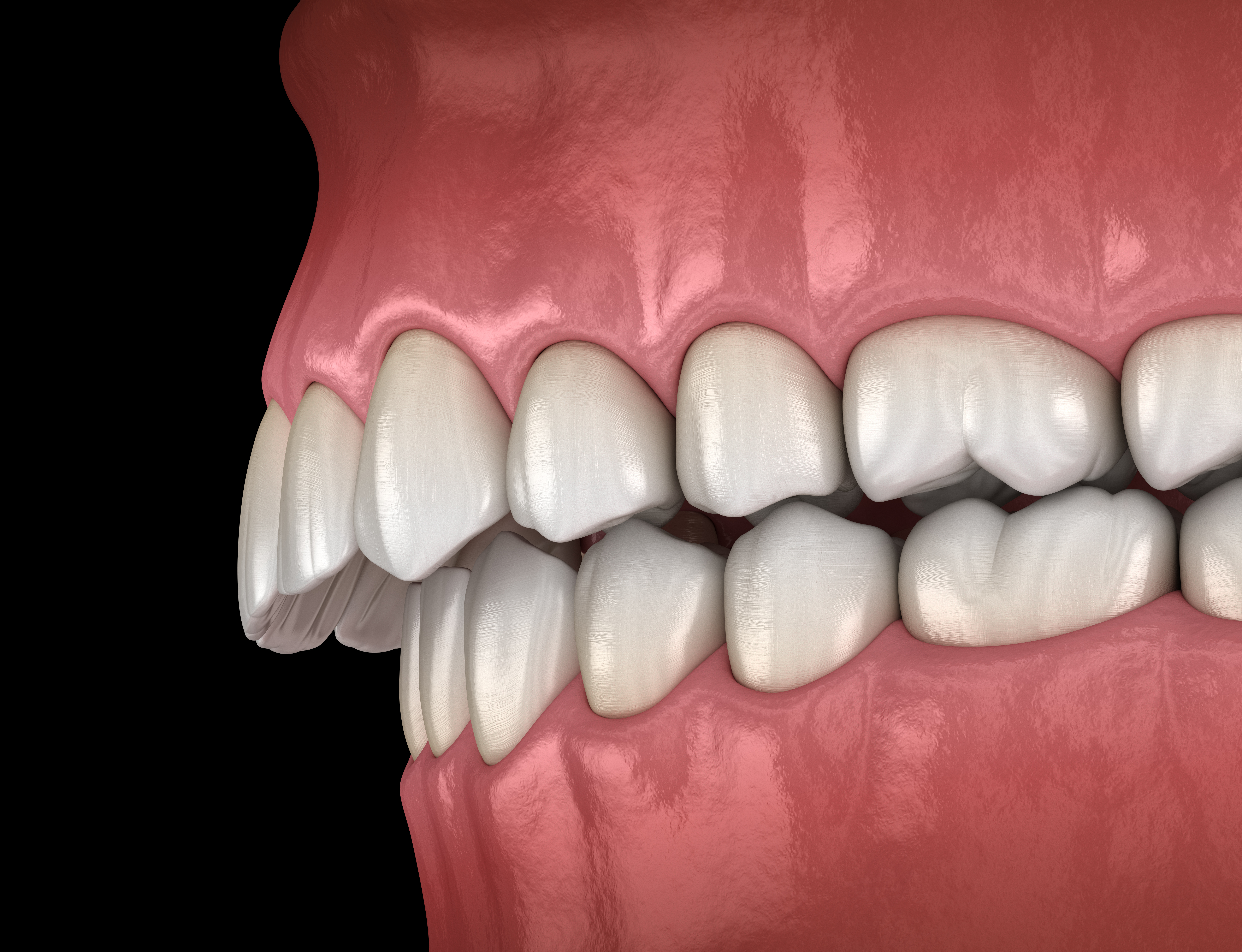 Ortodoncia Carlton - ¿Tienes problemas de roncopatía crónica