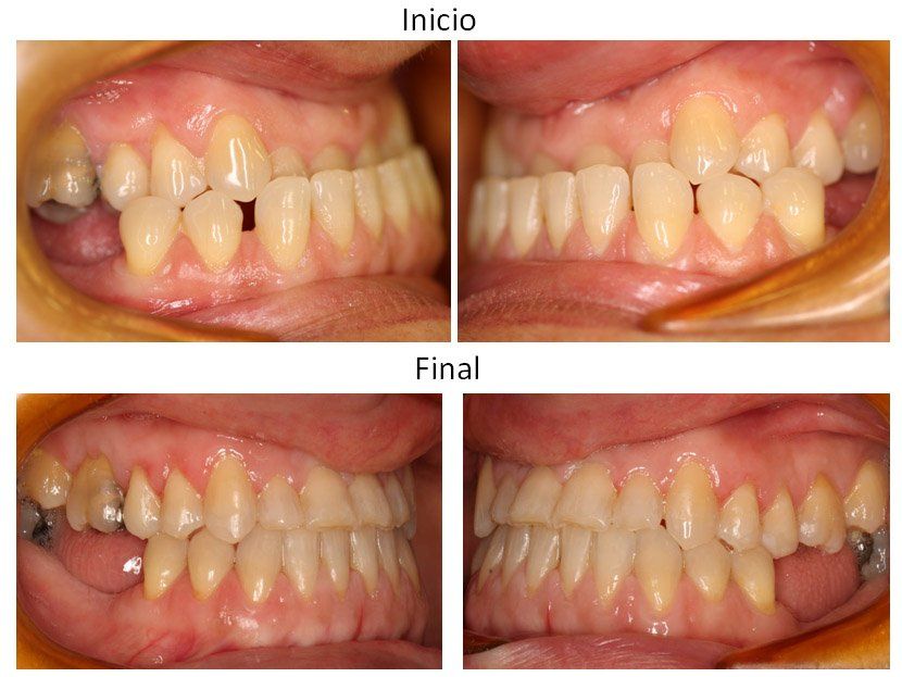 Ortodoncia Carlton caso 3 ortodoncia