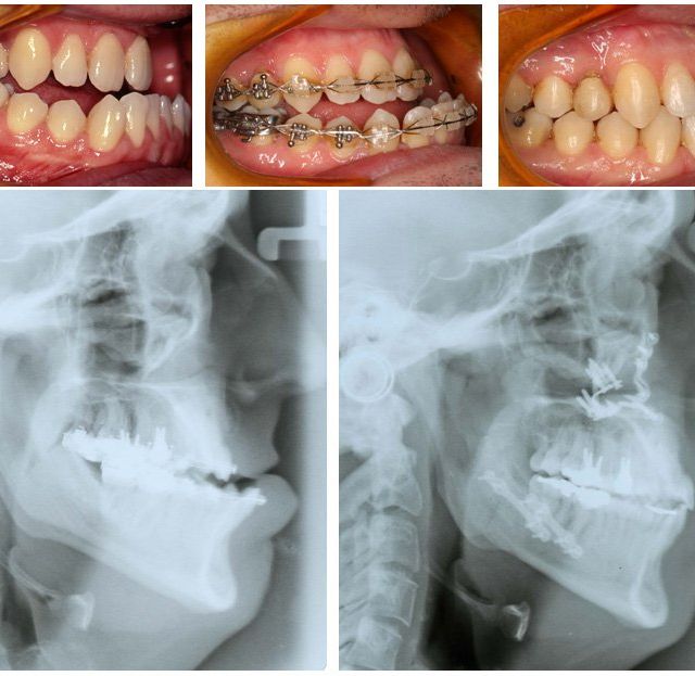 Ortodoncia Carlton caso 5 cirugía ortognática 