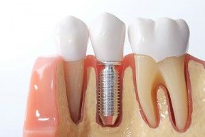 [company_name_branding] implante dental