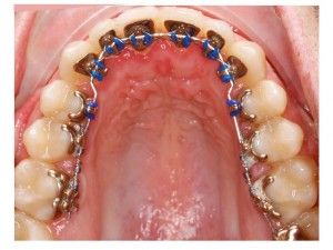  [company_name_branding]ortodoncia lingual superior
